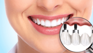 Dental Implants Service