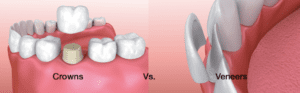 Dental Crowns vs. Veneers at Pinecrest Dental