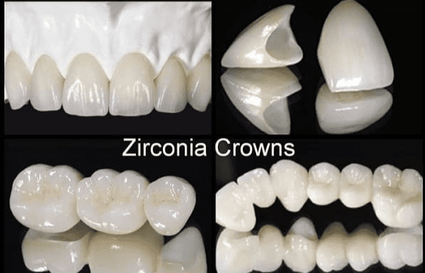 Zirconia Crowns at Pinecrest Dental
