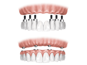 Deciphering All-on-4 vs. Traditional Dental Implants