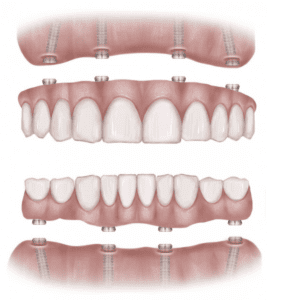 Dental Implants Service West Valley City UT
