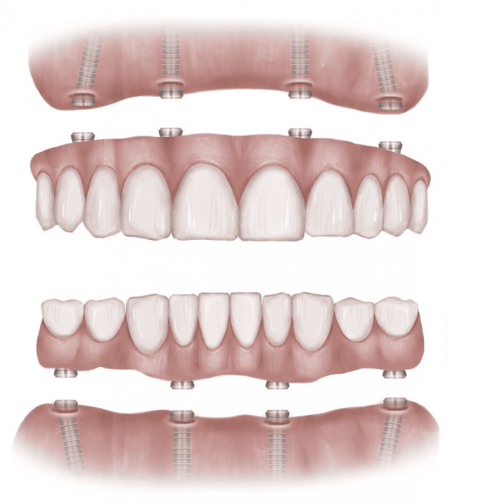 The Comprehensive Advantages of All-on Dental Implants: Pinecrest Dental