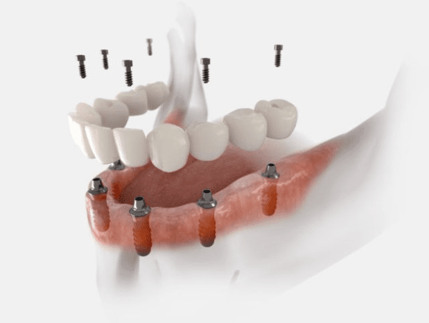 The All-on-6 Journey: From Consultation to Recovery | Pinecrest Dental