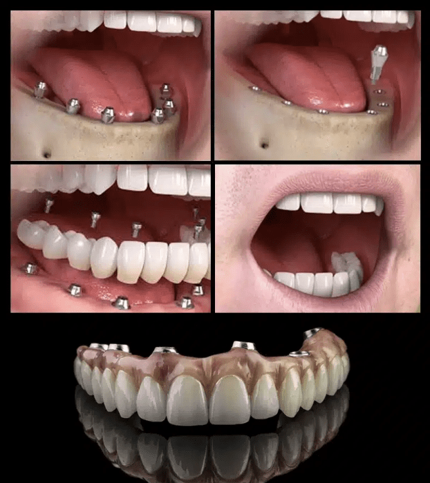 All-on-6 Implants vs. Traditional Dentures: A Comprehensive Comparison