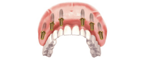 Pinecrest Dental | Temporary Tooth Replacement Dental Implant Treatment