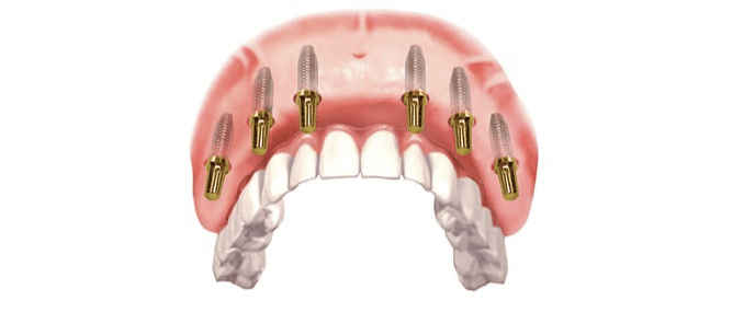 Safeguarding Your All-on-6 Smile: A Guide to Optimal Oral Health