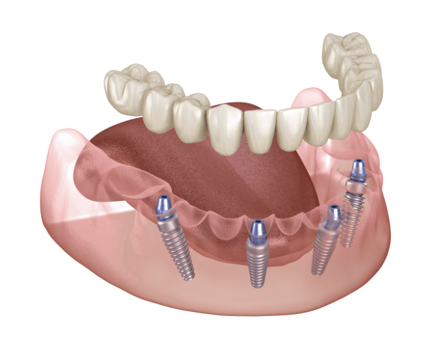 all-on-4 dental implant technique