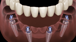 Pinecrest Dental | Dental Implants Near Me West Jordan UT Dental Implants West Jordan UT