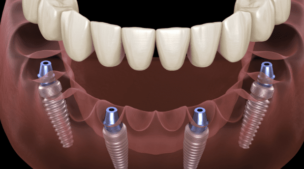 benefits of all-in-4 dental implants