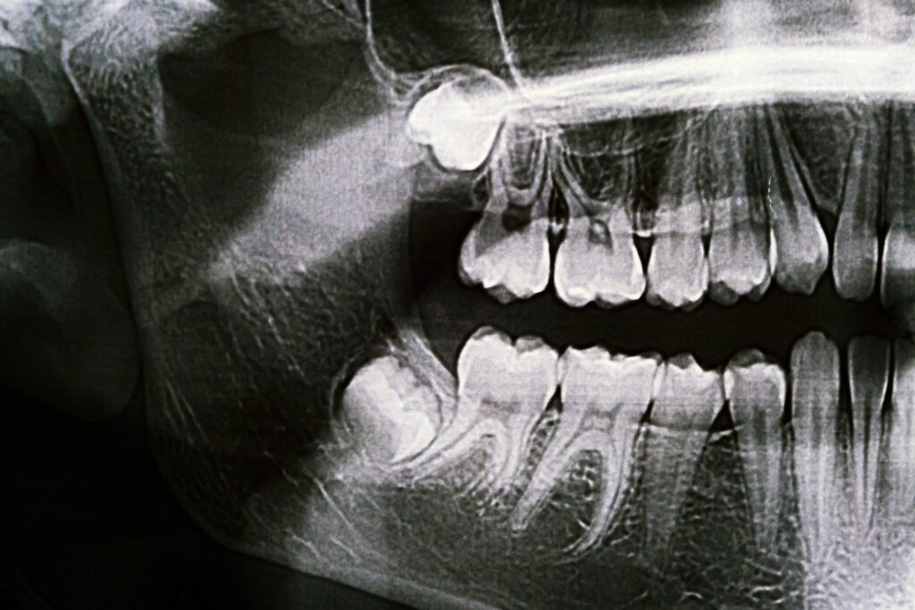 wisdom teeth removal